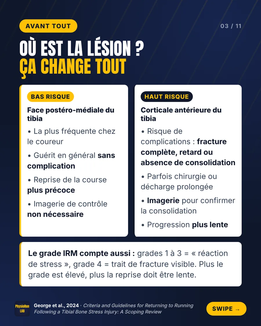 Fracture de fatigue du tibia : lésion à bas risque (face postéro-médiale) et à haut risque (corticale antérieure), et rôle du grade IRM pour la reprise de la course